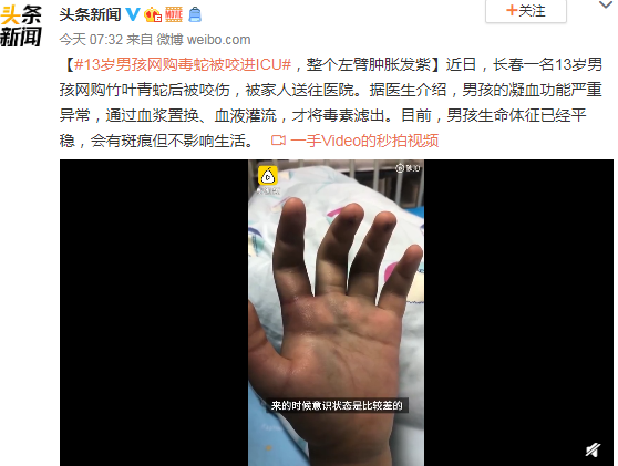 13歲男孩網(wǎng)購毒蛇被咬進(jìn)ICU 整個左臂腫脹發(fā)紫